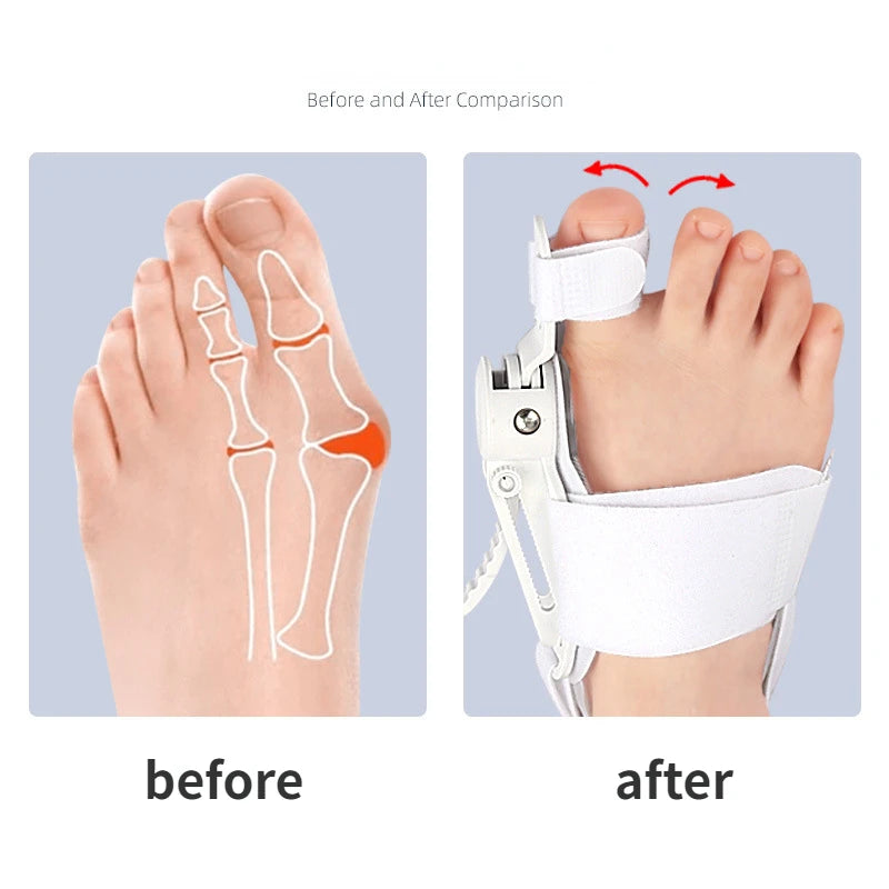 Bunifix™ Corrector for Bunions | 70% OFF + Free Nationwide Delivery - Last  Day!