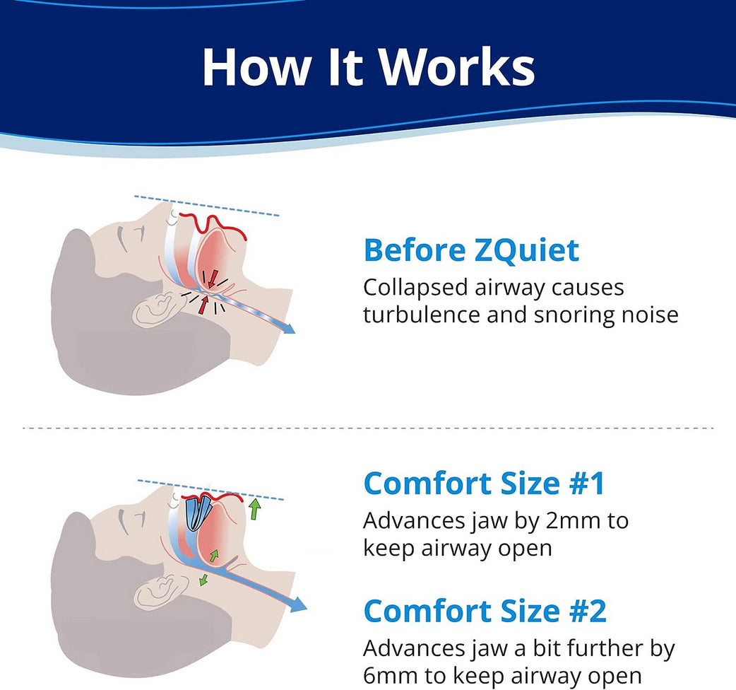ZQuiet® - Anti-Snoring Mouthpiece Universal Size  | Last  Day Of Sale!